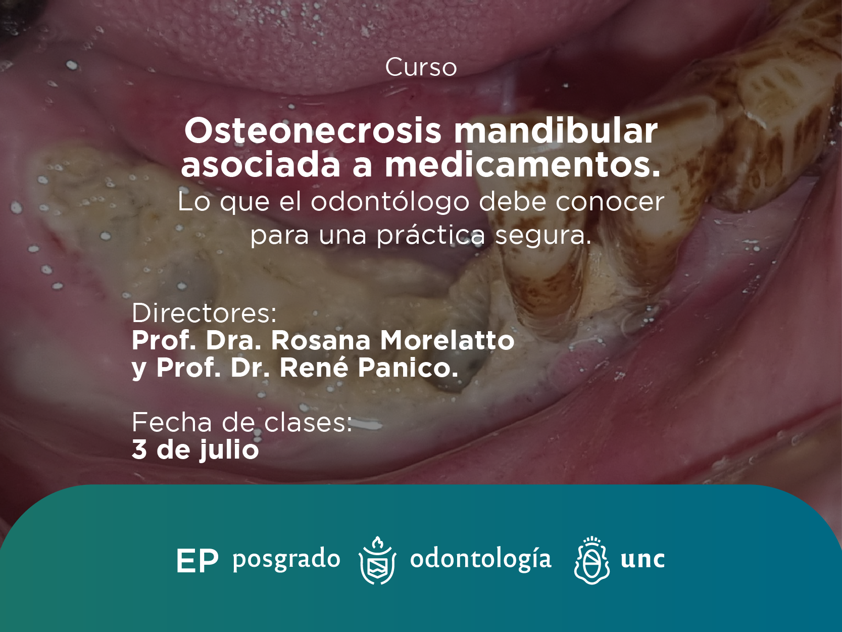 Osteonecrosis Mandibular Asociada a Medicamentos. Lo que el Odontólogo debe conocer para una Práctica Segura.